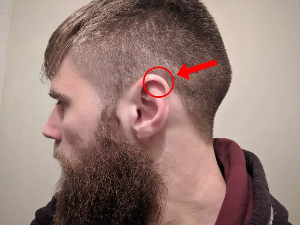 What You Need To Know About Cauliflower Ear In BJJ - Project BJJ